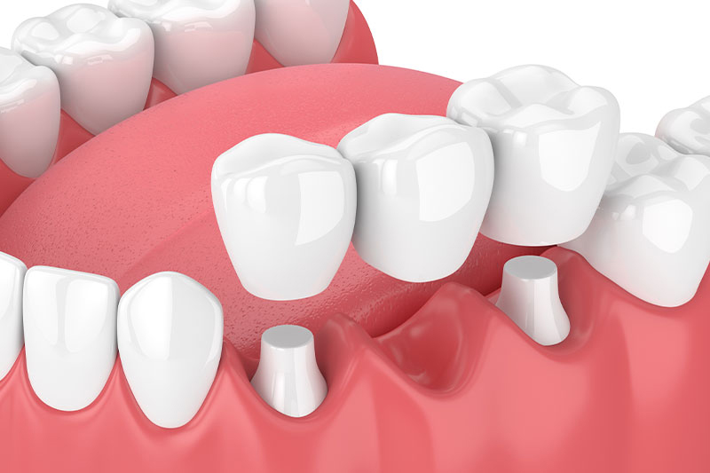 Dental Bridges in Oakbrook Terrace