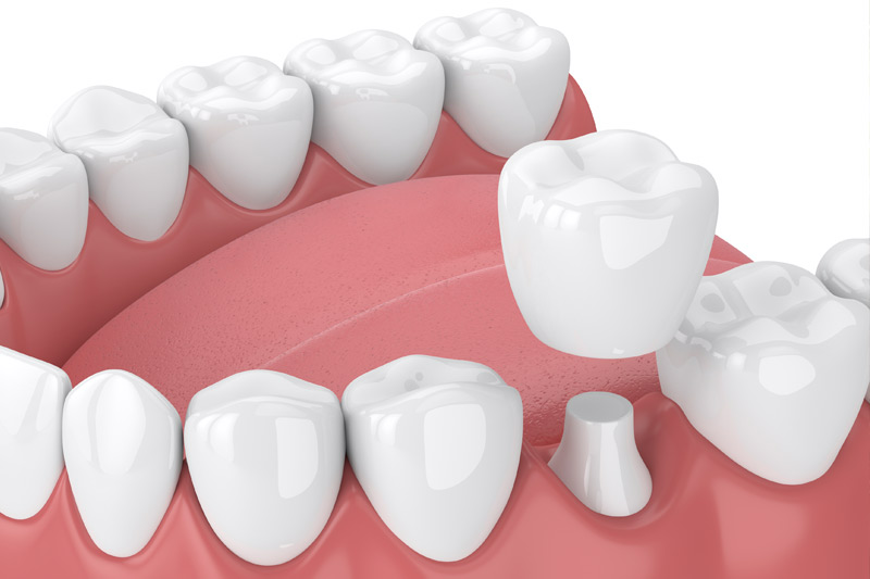 Dental Crowns in Oakbrook Terrace