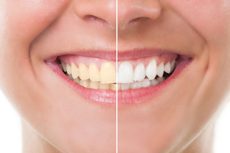 Teeth Whitening in Oakbrook Terrace
